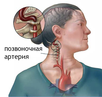 Защемление шейной аорты и всд. Симптомы и лечение защемления артерии в шейном отделе позвоночника