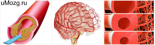 Расширение артериальных сосудов. Гипертонус сосудов головного мозга. Тонус сосудов головного.