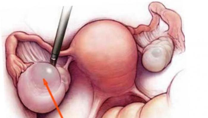 Simptomat e një kisti ovarian në të majtë Çfarë do të thotë një kist i vezores së majtë
