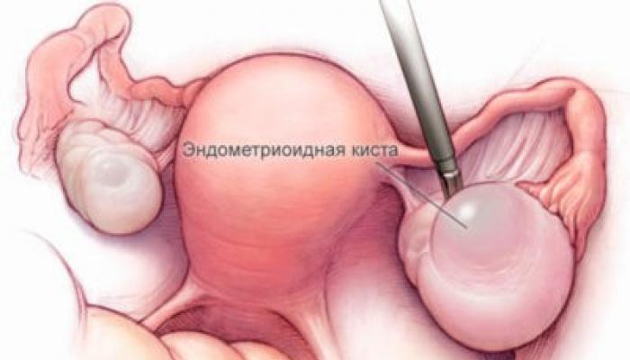 Pengobatan kista ovarium endometrioid tanpa operasi - ulasan pasien
